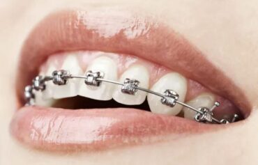 Ortodoncia con brackets