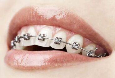 Ortodoncia con brackets